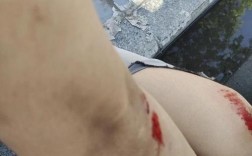 同一位置受伤，不同公司责任如何划分？