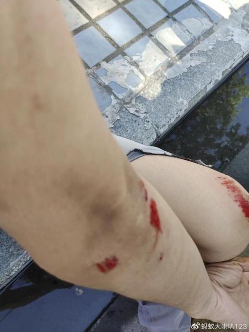 同一位置受伤,不同公司责任如何划分?-图1 同一位置受伤,不同公司责任如何划分?-图1